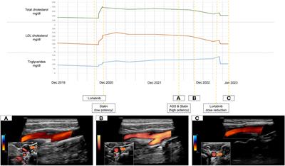 Case report: Dissolving carotid plaque associated to Lorlatinib-related dyslipidemia